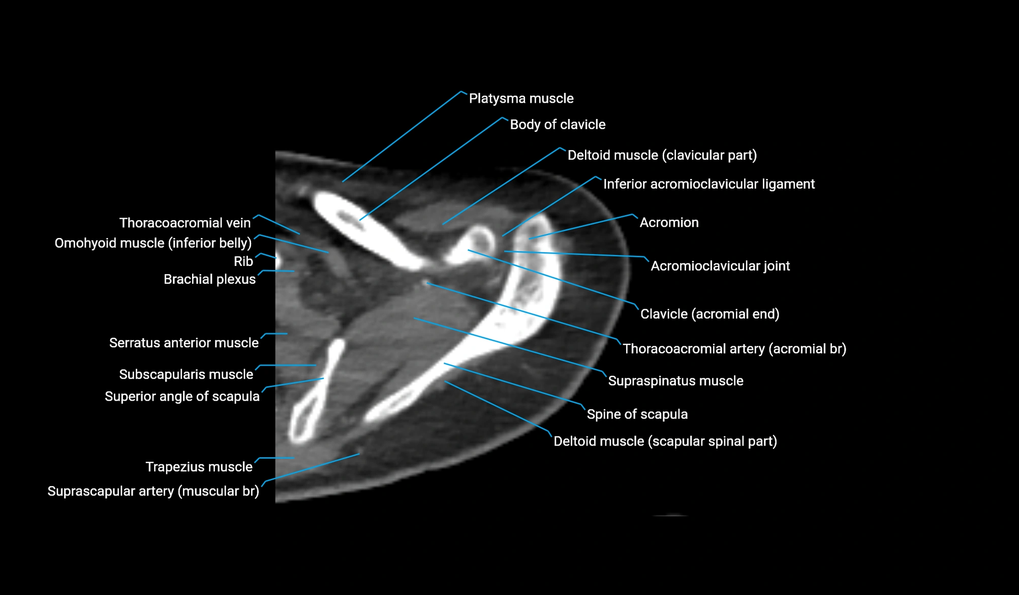 CT upper arm axial  cross sectional anatomy labelled radiology image -00064.webp